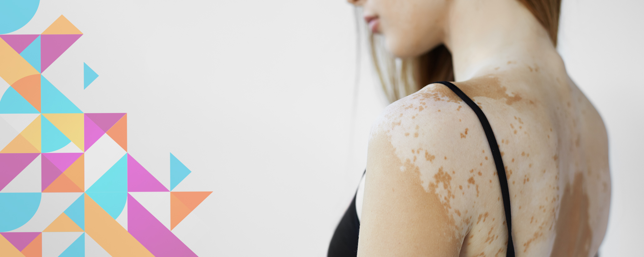 vitiligo foto